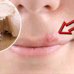 herpes-bijeli-luk-prirodni-nacin