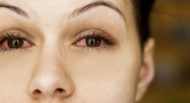 oci-crvene-iritacija-crvenilo-upala