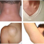 masno_tkivo_ispod_kože