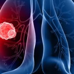 rak-pluca