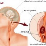 simptomi_moždanog_udara-300x156