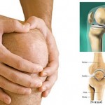 artroza_kolena1