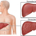 ciroza_jetre_simptomi