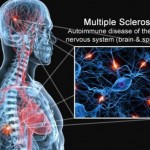 multipla_skleroza (1)
