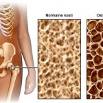 osteoporoza3