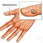 bradavice