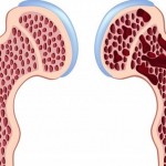 Osteoporoza