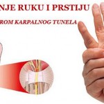 trnjenje_ruku_sindrom_karpalnog_kanala1