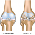 zdravi-zglob-koljena-e14242515115421