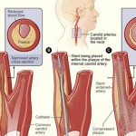 krvne-žile-holesterol