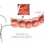 polipi_na_debelom_crevu_simptomi1
