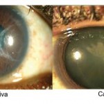 konjuktiva-katarakta