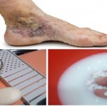 magični-recept-tromboza