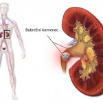 bubrezni-kamenac