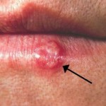 Herpes-620x350