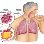 pneumonia
