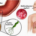 heliko_bakterija_simptomi1