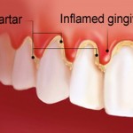 gingivitis-kamenac