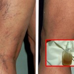 vene_na_nogama_prije_i_poslije_tretmana