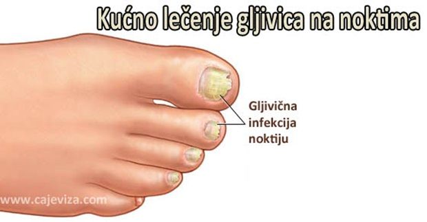 Gljivice-na-noktima1