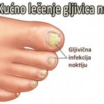Gljivice-na-noktima