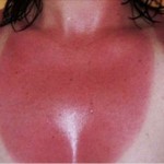 izgorjeti-na-suncu-1