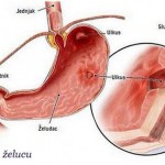 cir_na_zelucu_simptomi