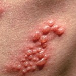 herpes