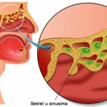 zacepljeni-sinusi