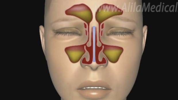 Printskrin: YouTube/Alila Medical Media