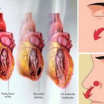 Visok-krvni-pritisak