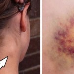 promjene-na-tijelu-rak