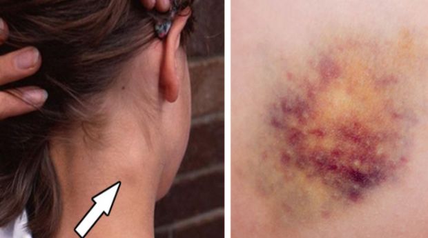 promjene-na-tijelu-rak