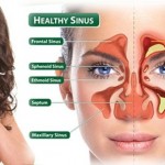 sinusitis