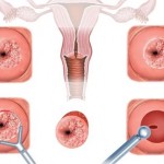 ranica-na-grlicu-materice-simptomi