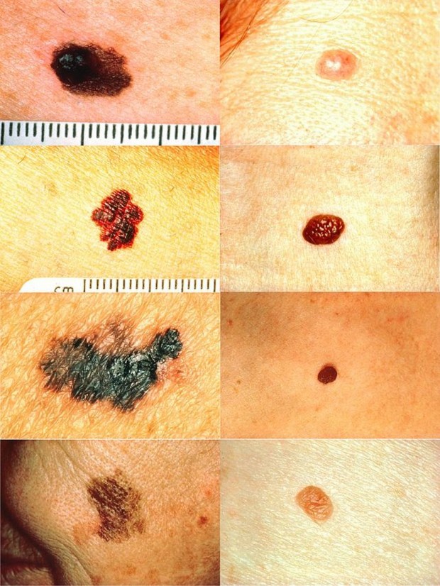 Foto: Wikimedia/Stevenfruitsmaak / Melanoma, PD US NIHFoto: Wikimedia/Stevenfruitsmaak / Melanoma, PD US NIH