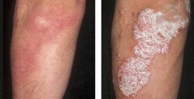 psorijaza-foto