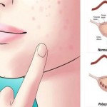 policisticni-jajnici