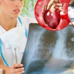 Rak-pluca-670x446-620x350