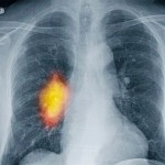 rak-pluca