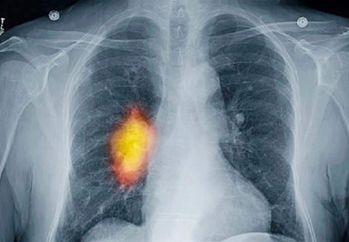 rak-pluca