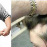 Opadanje-kose-gojaznost