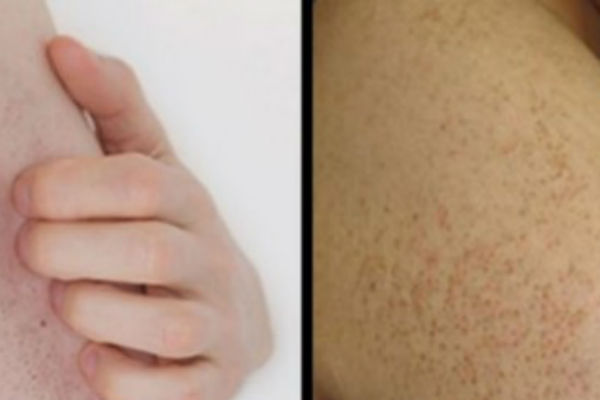 crvene-tackice-na-rukama