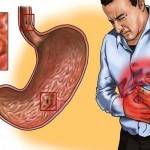 gastritis