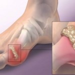 mokracna-kiselina-u-zglobovima-giht-lecenje-i-simptomi