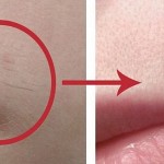 uklanjanje-dlacica-2