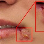herpes-usna