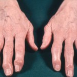 artritis
