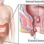 hemoroidi