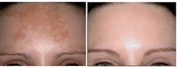 lasersko-podmladjivanje-f